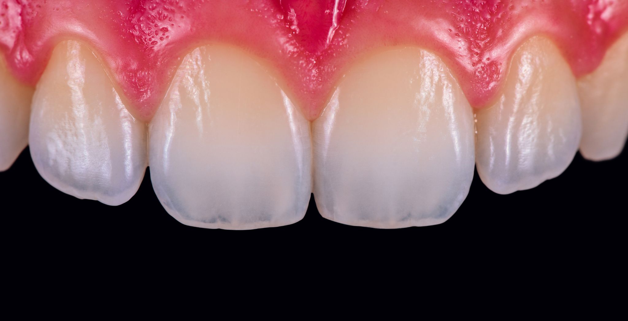 How to Restore Tooth Enamel, Restore tooth enamel, Enamel restoration methods, How to repair enamel