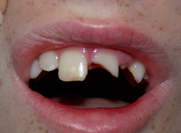 tooth break